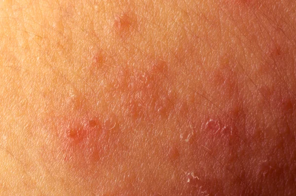 Eczéma dermatite atopique symptôme texture de la peau — Photo