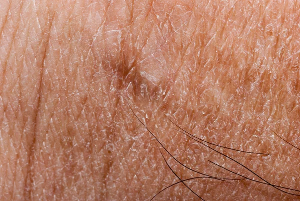 Dry skin texture — Stock Photo, Image