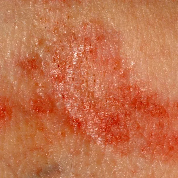 Кожа аллергического дерматита с сыпью — стоковое фото