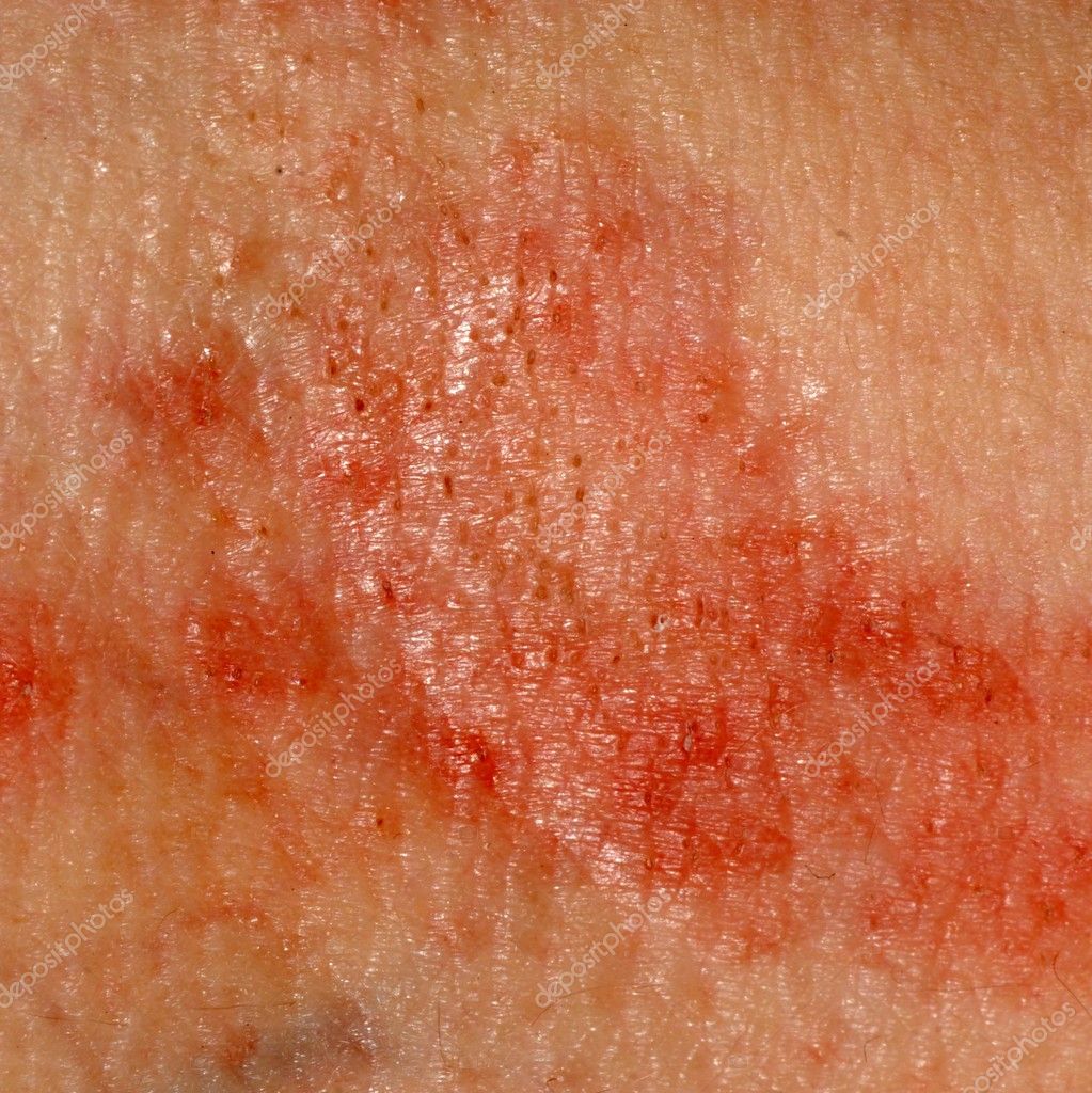Dermatite Cutanée éruption Cutanée Allergique Image Libre De Droit Par