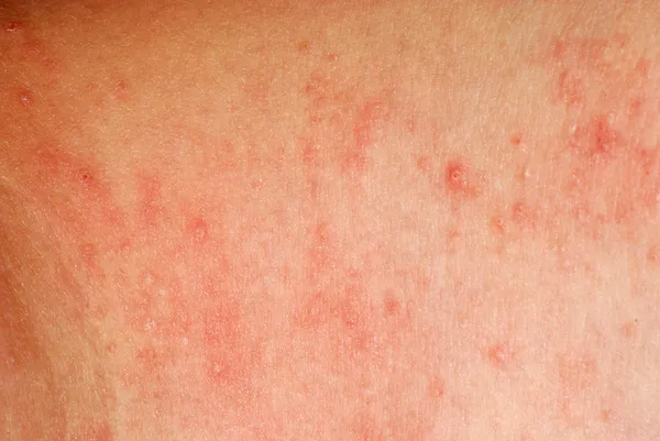 Allergiska utslag eksem hud textur — Stockfoto