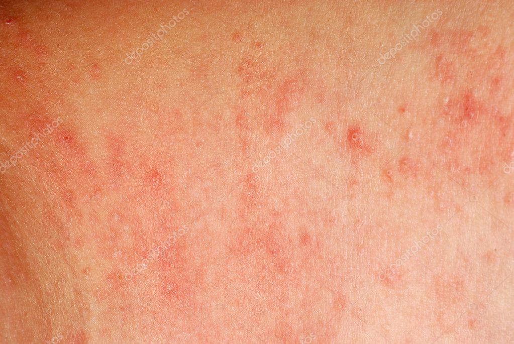 Erupción Alérgica Dermatitis Textura De La Piel 2022