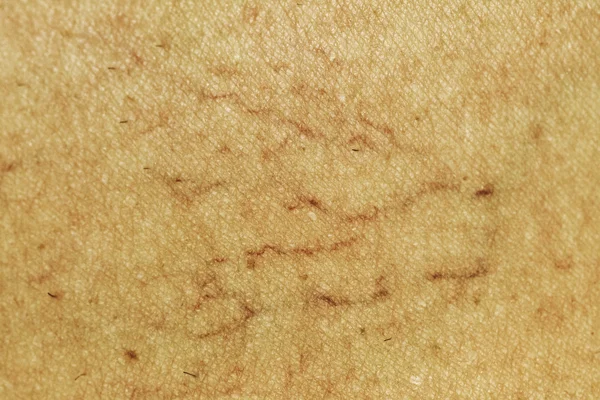 Venas varicosas en la pierna Macro — Foto de Stock