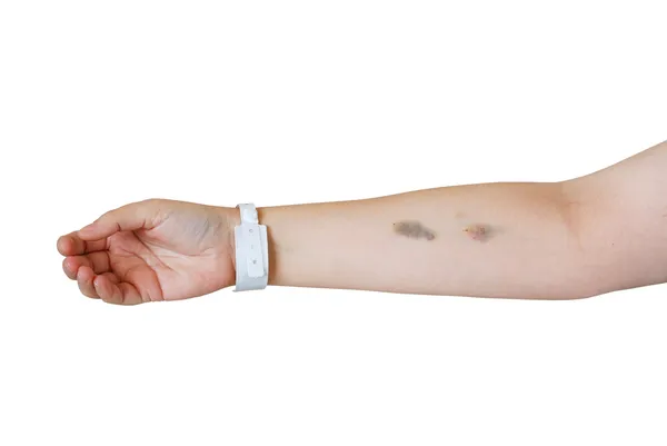 Arm med injektion blåmärken och sjukhuset armband — Stockfoto