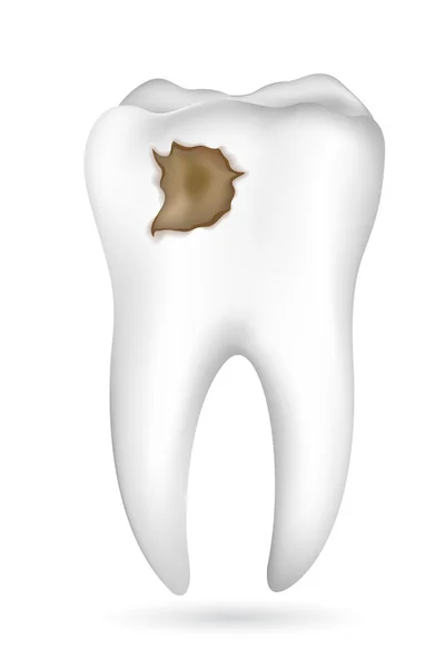 Cavidad en el diente — Archivo Imágenes Vectoriales