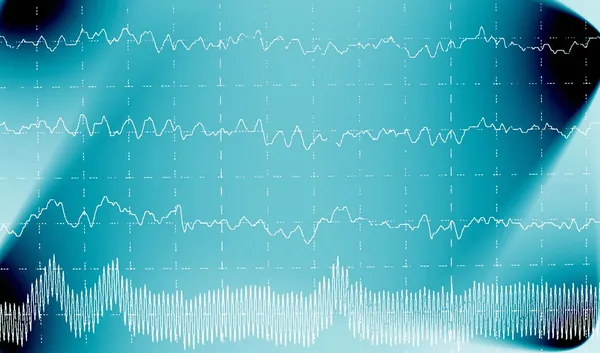 Хвиля мозку на електроенцефалограмі ЕЕГ для епілепсії — стокове фото