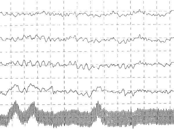 Grafico onda cerebral EEG isolado em fundo branco — Fotografia de Stock