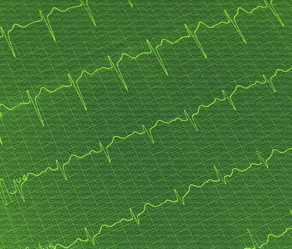 Γράφημα ΗΚΓ, Ηλεκτροκαρδιογράφημα ΗΚΓ πράσινο φόντο, υφή — Φωτογραφία Αρχείου
