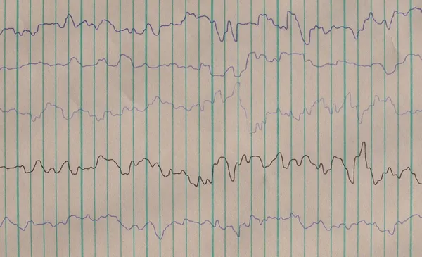 Brain waves on encephalogramme, EEG — Stock Photo, Image