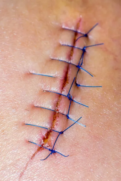 Stitches — Stock Photo, Image