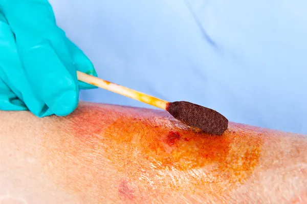 Doctor cleaning wound — Stock Photo, Image