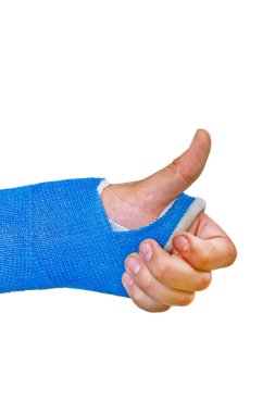 Broken arm, thumb´s up