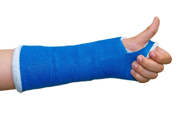 Сломанная рука, большой палец вверх — стоковое фото