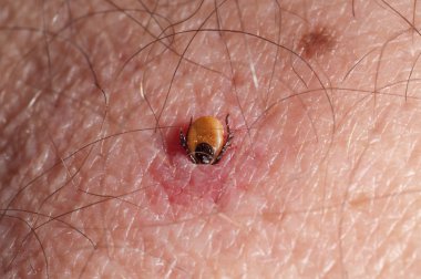 Tick burrowing in human skin clipart
