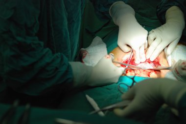 New Born Infant In The Operation Room