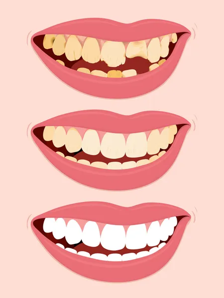 Etapas progresivas de la caries de caries dental — Vector de stock