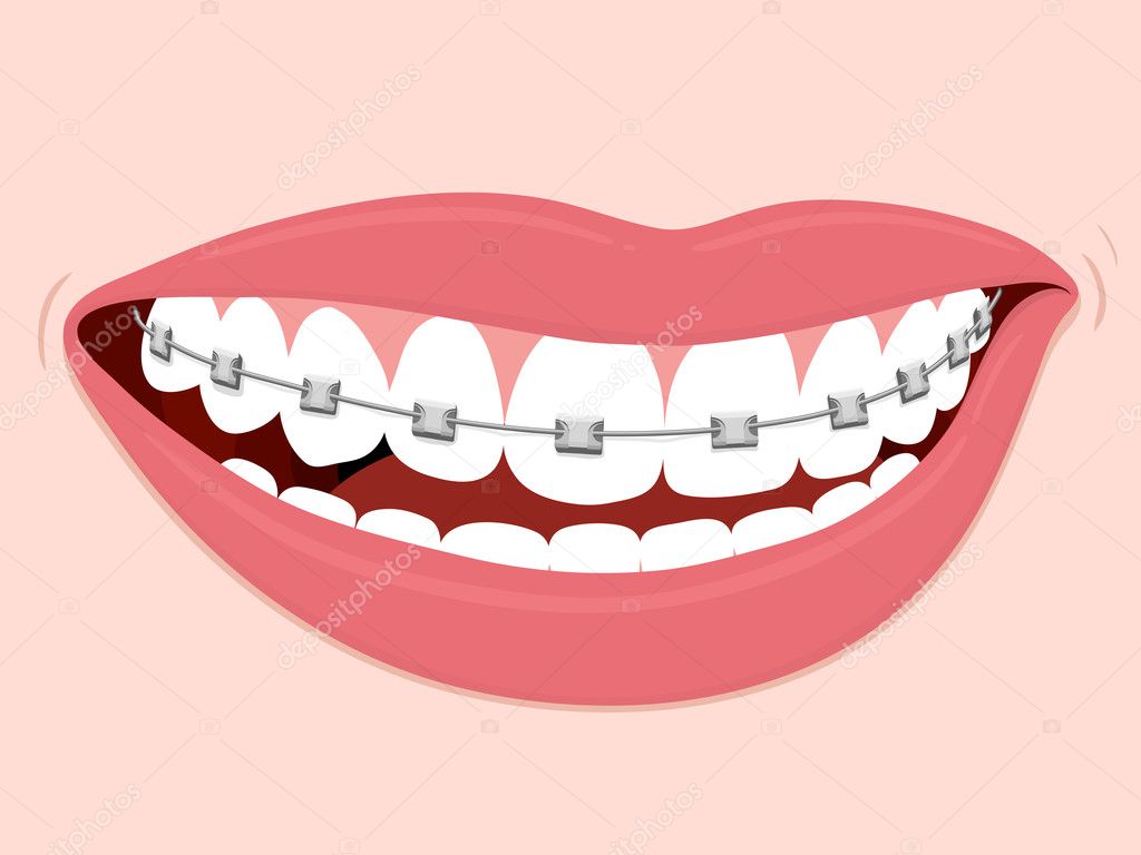 Braces Corrective Orthodontics