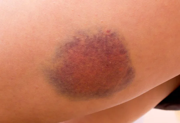 Bruise on a leg — Stock Photo, Image