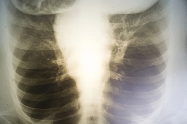 Röntgenaufnahme der Brust von Frauen Stockbild