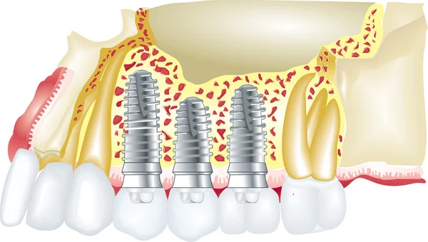 Имплантаты зубов — стоковый вектор