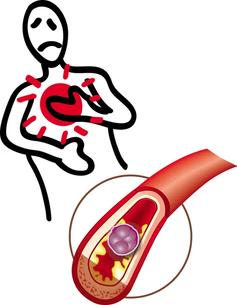 Herzinfarkt — Stockvektor