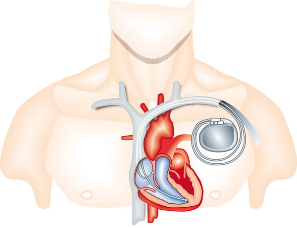心脏起搏器 — 图库矢量图片