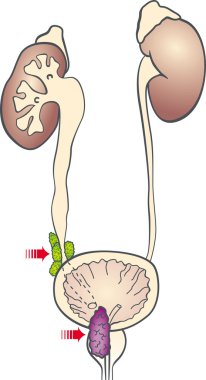 Prostate cancer clipart