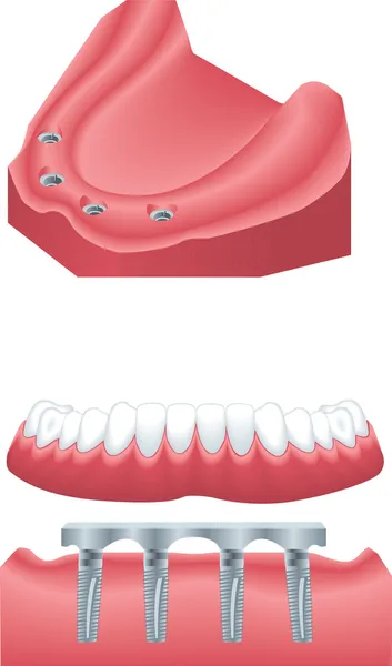 牙科植入物 — 图库矢量图片