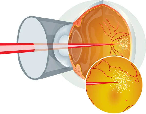 Laser oogchirurgie — Stockvector