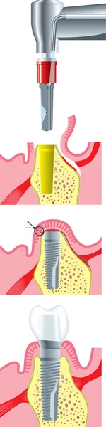 Zahnchirurgie — Stockvektor