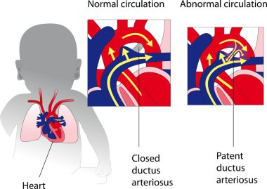 Patent ductus arteriosus. Medicine poster clipart