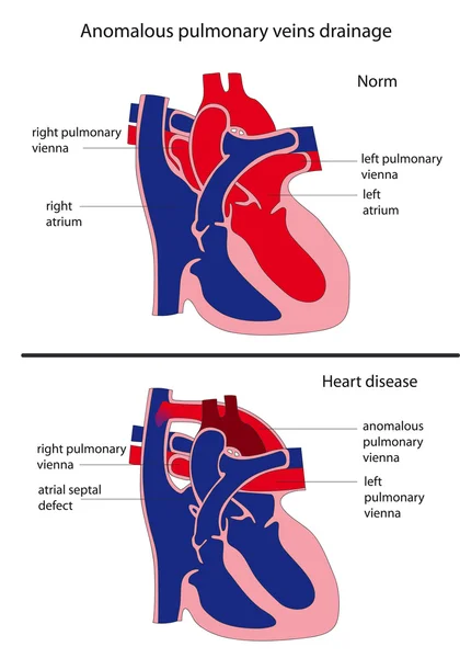 Anomale Drainage der Lungenvenen. Herzkrankheit. — Stockvektor
