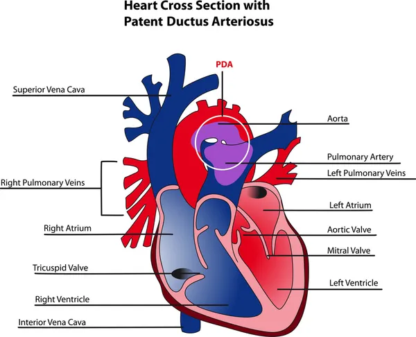 Corte transversal del corazón con conducto arterioso permeable — Vector de stock