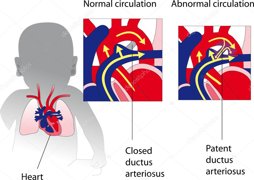 Patent ductus arteriosus. Medicine poster