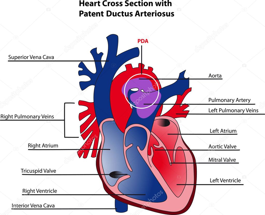 hart doorsnede met patent ductus arteriosus — Stockvector ...
