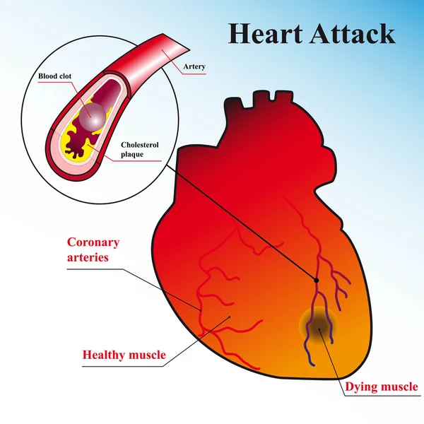 Schematic explanation of the process of heart attack — Stock Vector