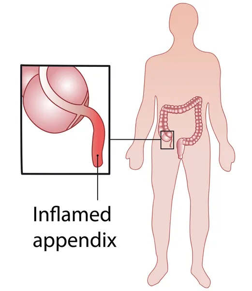 Inflammerad appendix i den mänskliga kroppen. medicinsk affisch — Stock vektor