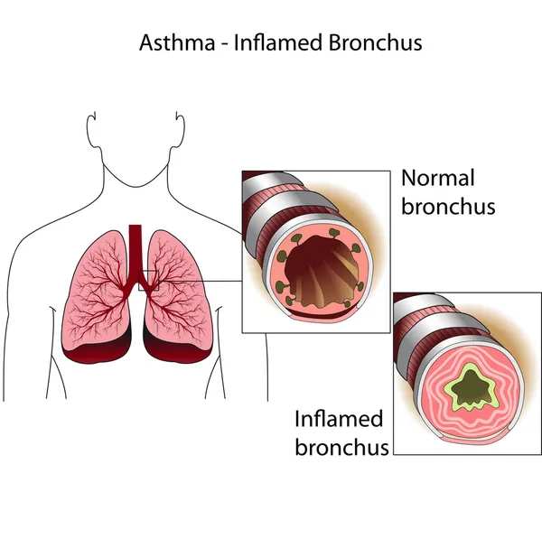 Los bronquios de una persona sana y una persona que sufre de bronquios — Archivo Imágenes Vectoriales