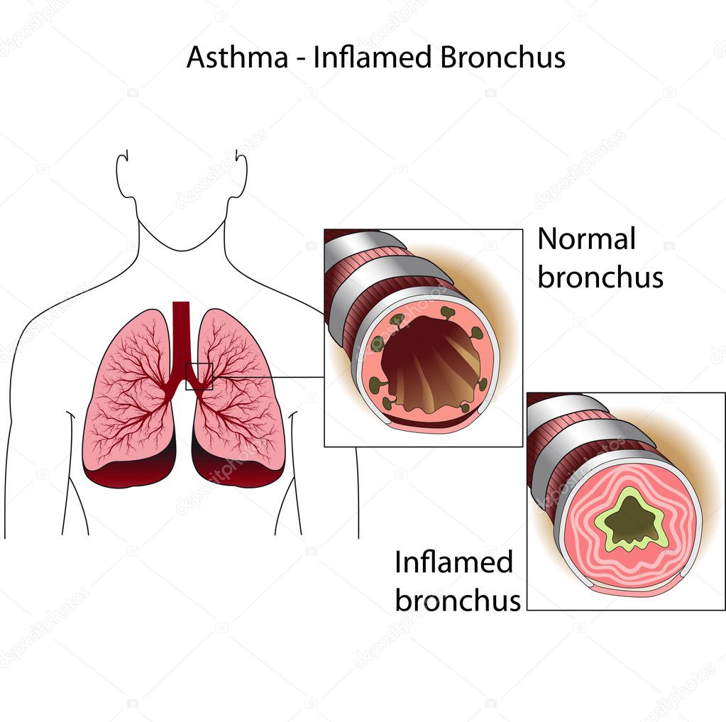 The bronchial tubes of healthy person and a person suffering from bronchia