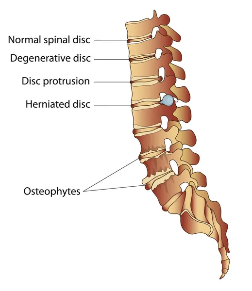 Algunas enfermedades espinales: hernia discal, osteofitos, cambios degenerativos en — Vector de stock