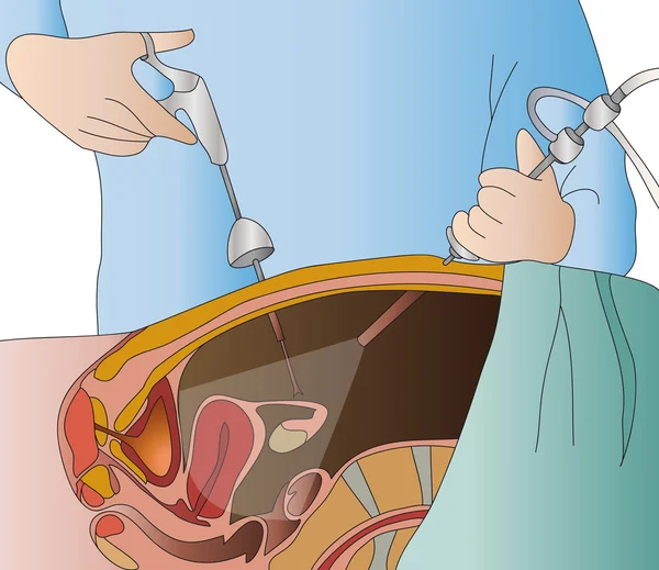 Cirurgia laparoscópica — Vetor de Stock