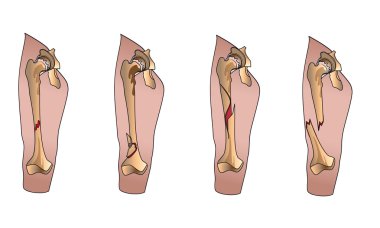 Types of fractures clipart