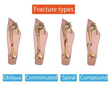 Types of bone fractures leg clipart