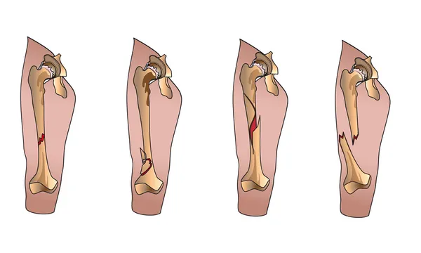 Types of fractures — Stock Vector
