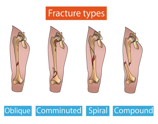 Tipos de fracturas óseas pierna — Archivo Imágenes Vectoriales