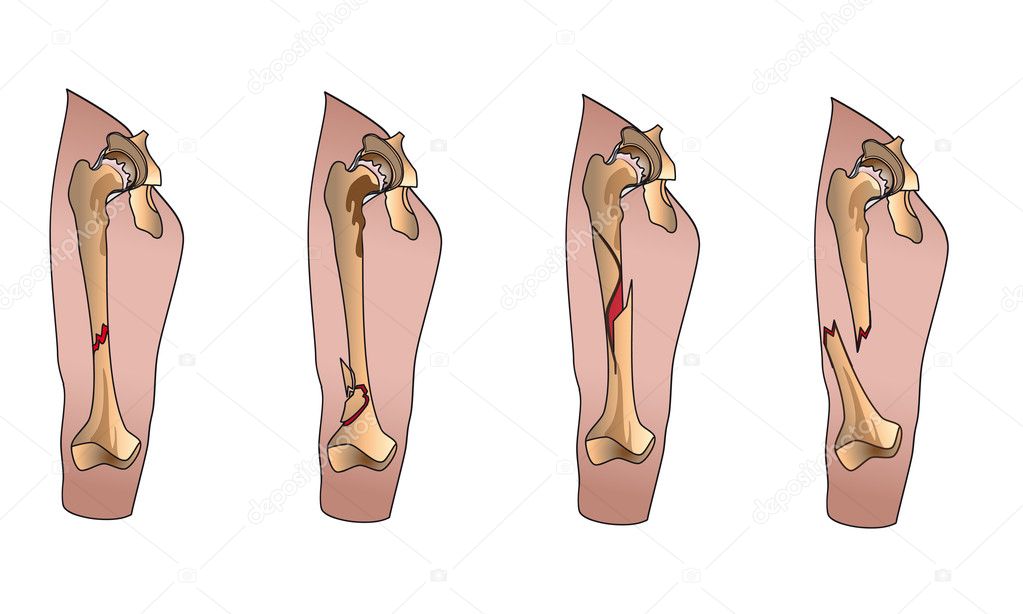 Types of fractures