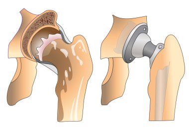 Hip prosthesis clipart