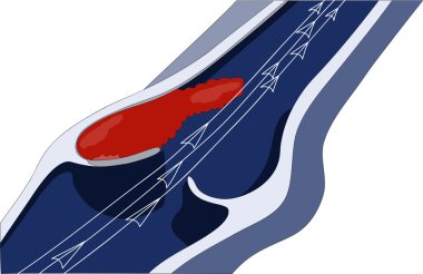 The formation of a clot (thrombus) in the larger veins of the area clipart