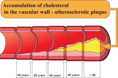 Accumulation of cholesterol in vascular walls. Poster clipart