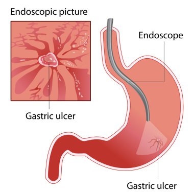 Gastric ulcer clipart